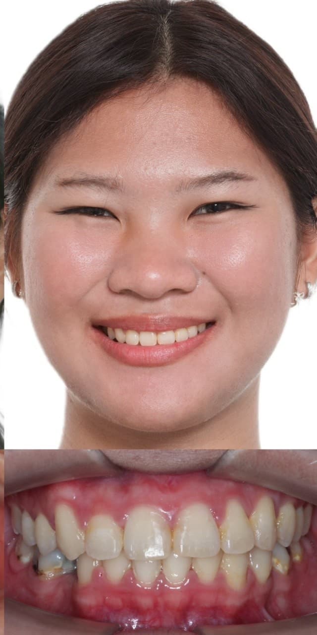 จัดฟันลดฟันซ้อนเก - After
