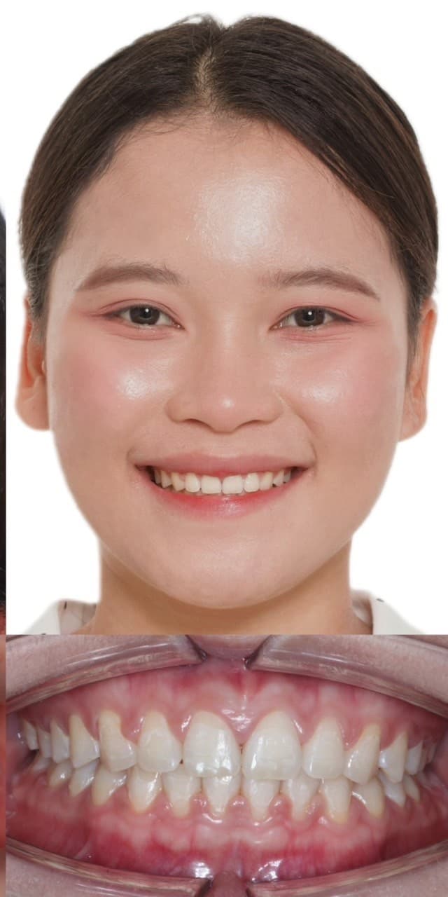จัดฟันลดฟันห่างและปรับรอยยิ้ม - After