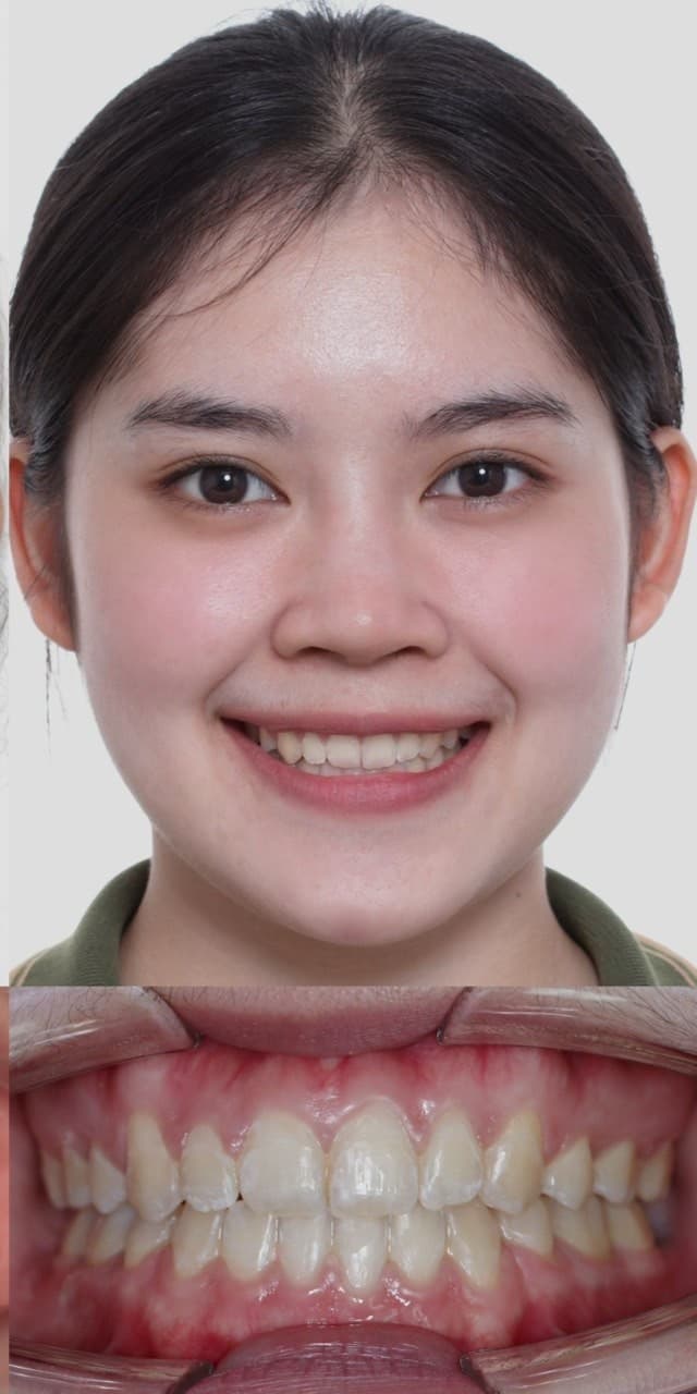 จัดฟันลดฟันยื่นและปรับรอยยิ้ม - After