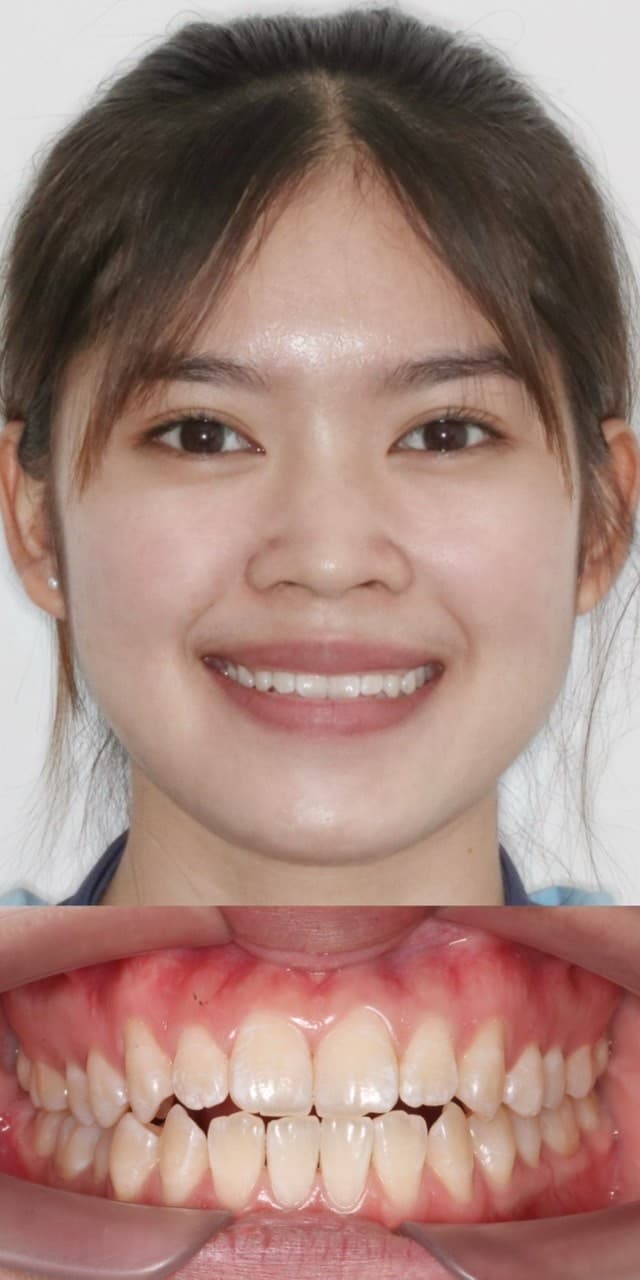 จัดฟันลดฟันยื่นและปรับรอยยิ้ม - Before