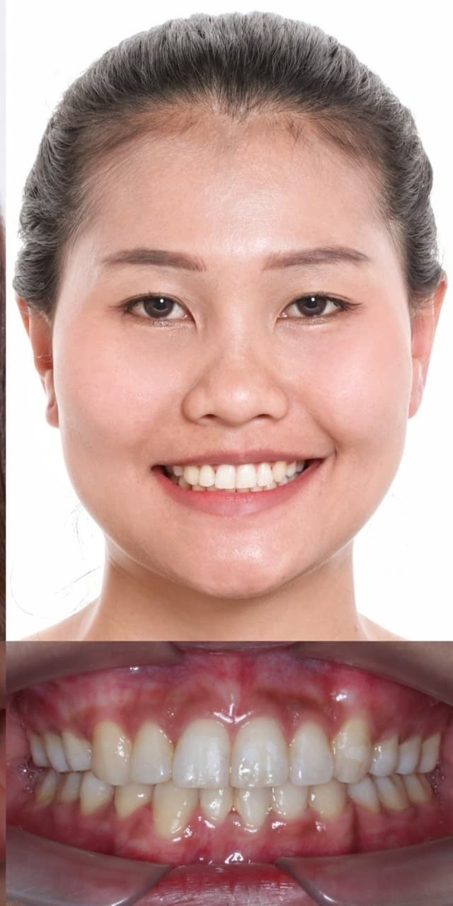 จัดฟันลดฟันซ้อนเก - After