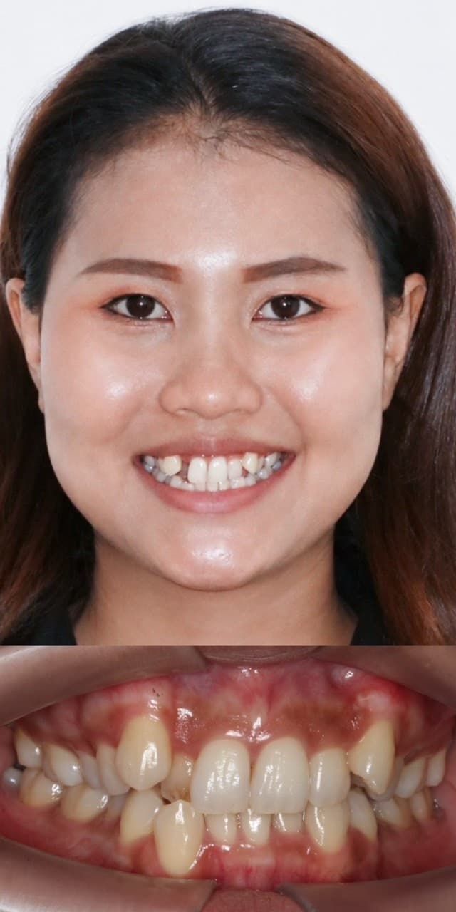 จัดฟันลดฟันซ้อนเก - Before