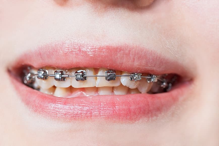 Damon-Braces