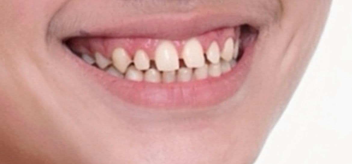 วีเนียร์คอมโพสิตเปลี่ยนรูปร่างฟัน - Before