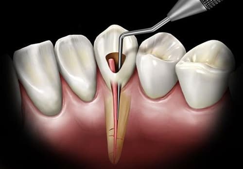 Root canal treatment