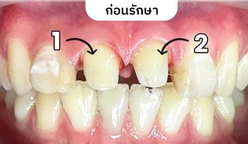ครอบฟัน - Before