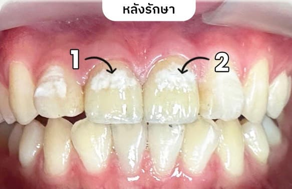 ครอบฟัน - After