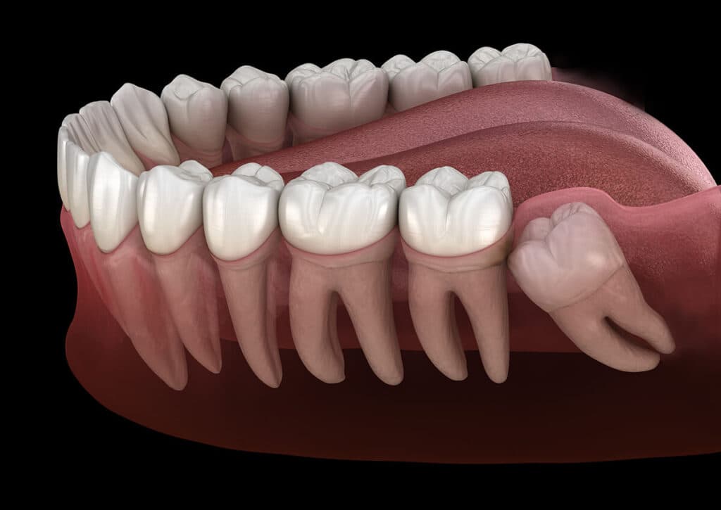 Wisdom tooth extraction