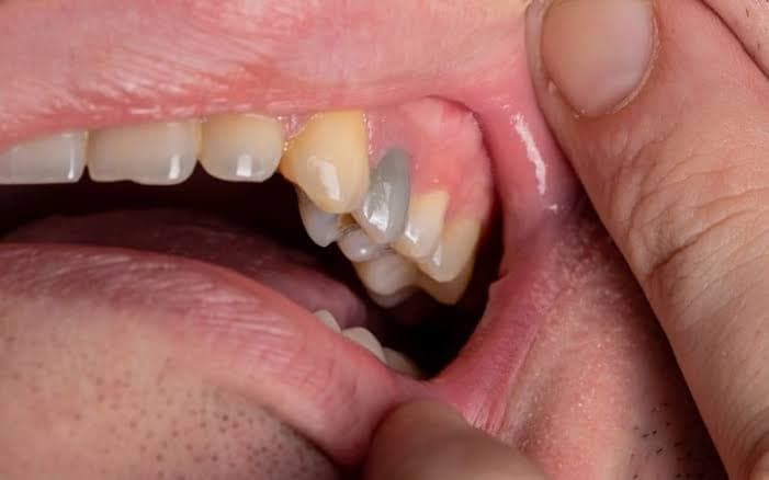 Teeth that have turned an abnormally dark color.