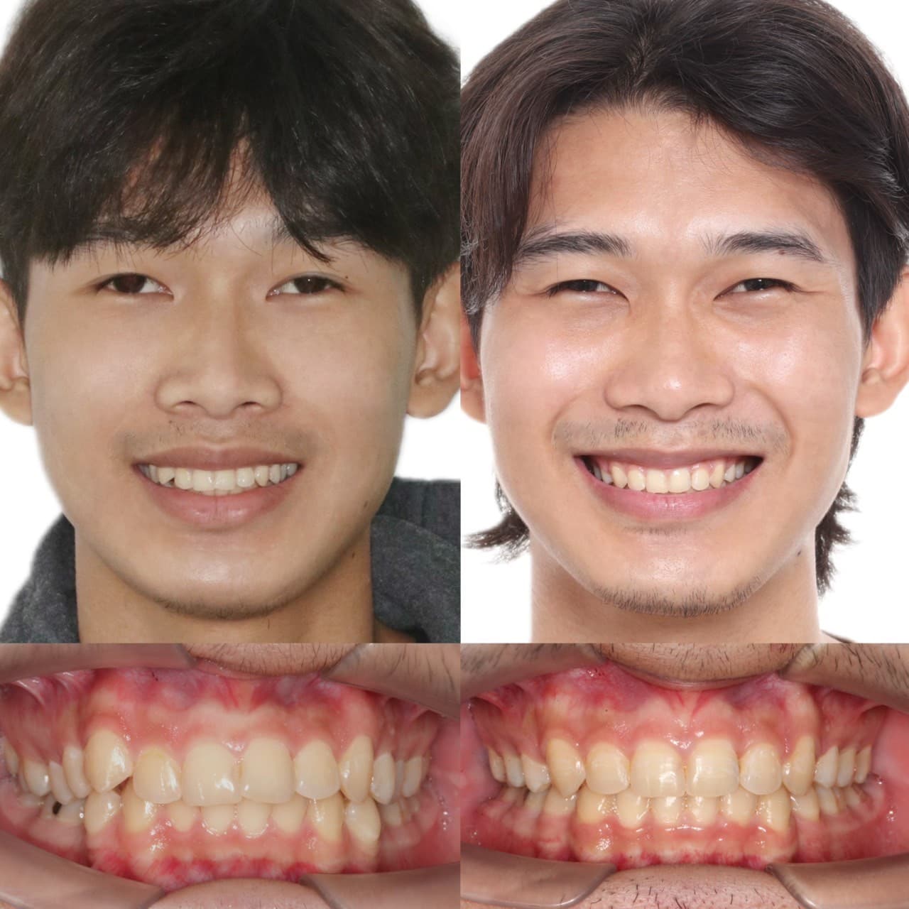 ผลลัพจัดฟันใส