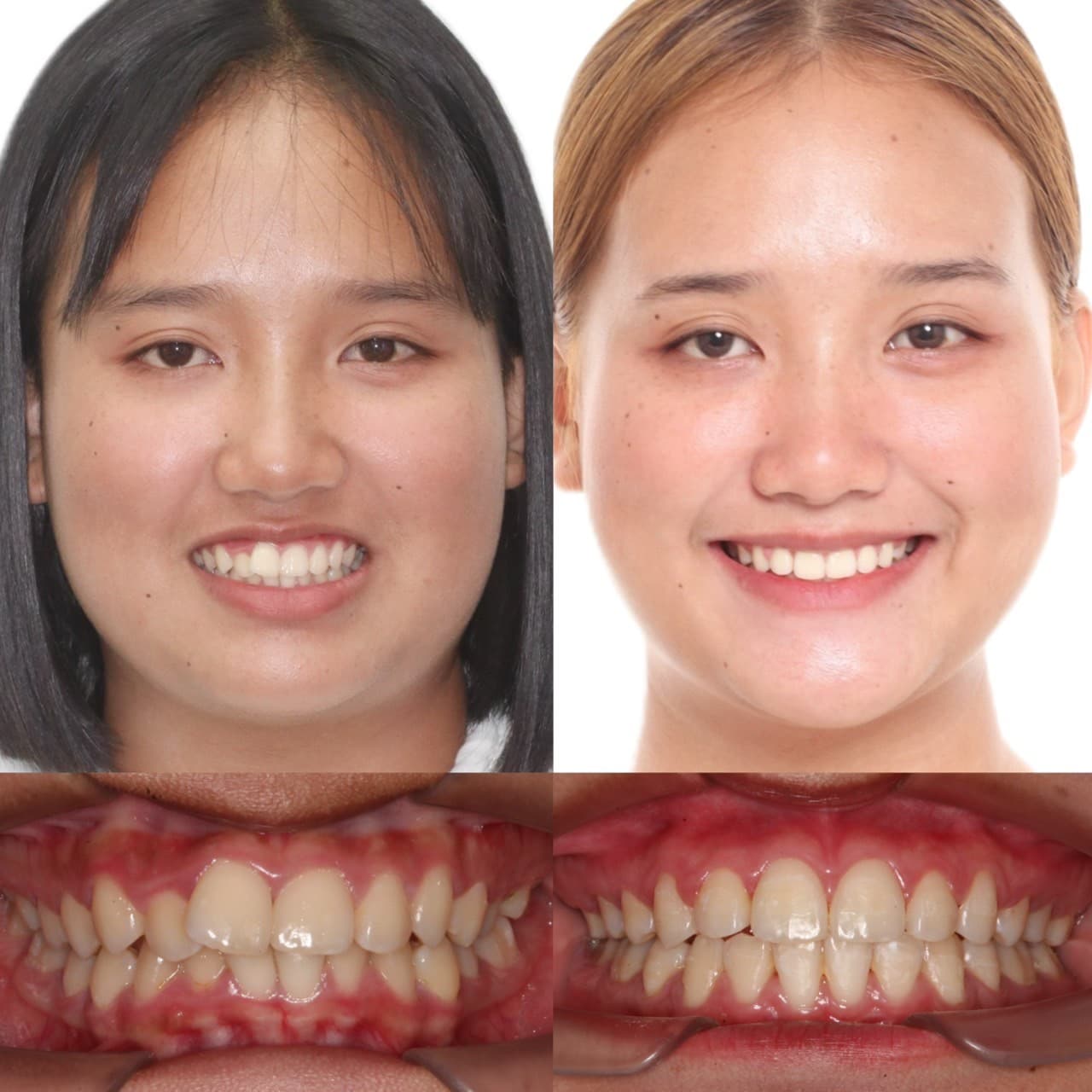 Results of metal braces