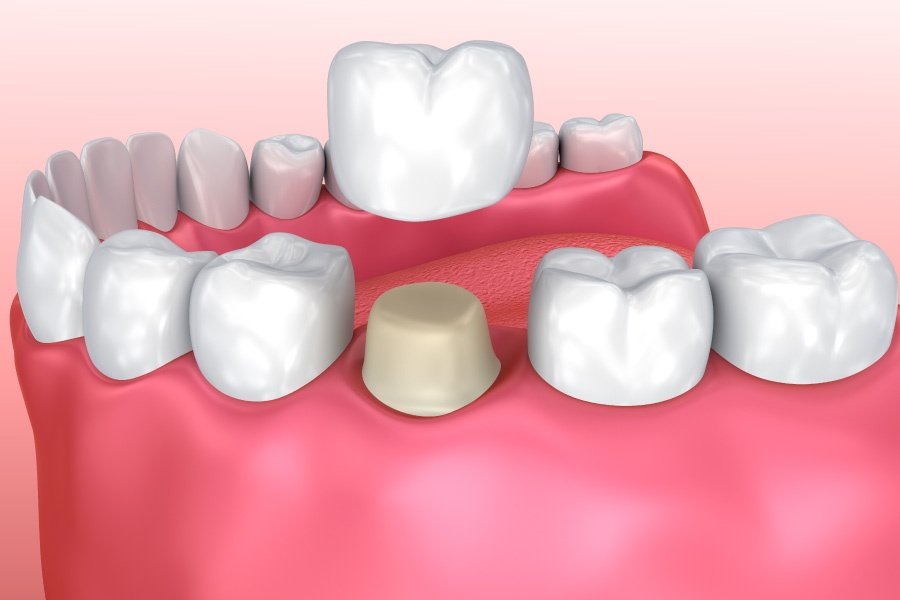 ครอบฟัน จัดฟัน คลินิกทันตกรรมอุดรธานี คลินิกทันกรรม หนองบัวลำภู Panda Dental Clinic