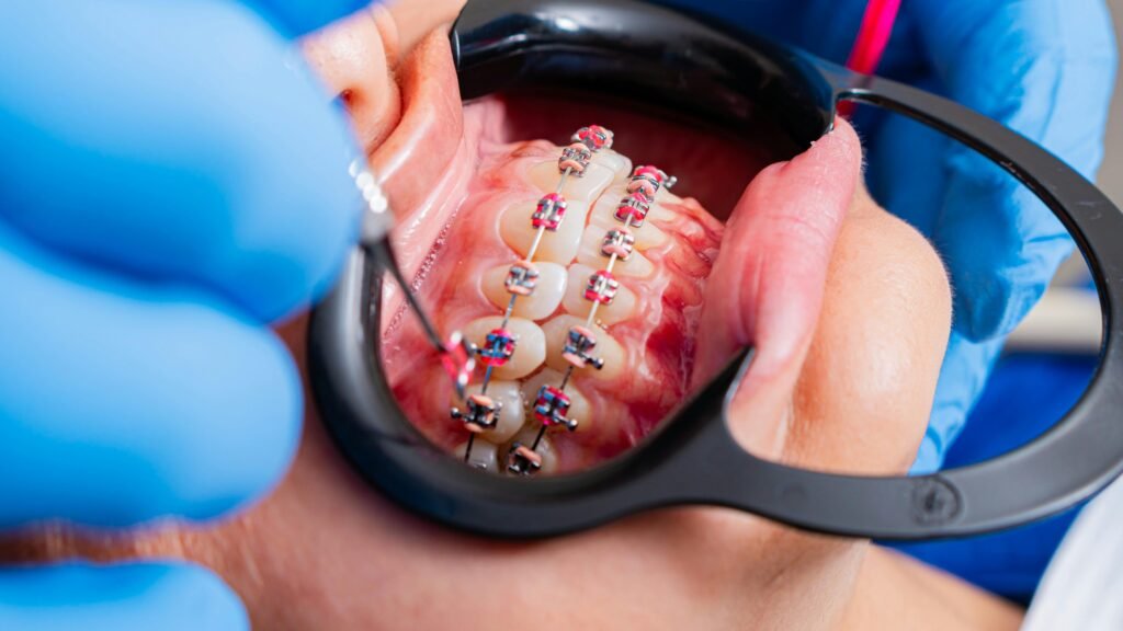 จัดฟัน คลินิกทันตกรรมอุดรธานี คลินิกทันกรรม หนองบัวลำภู Panda Dental Clinic