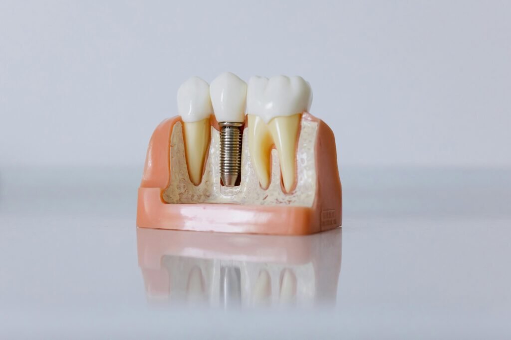 รากฟันเทียมจัดฟัน คลินิกทันตกรรมอุดรธานี คลินิกทันกรรม หนองบัวลำภู Panda Dental Clinic