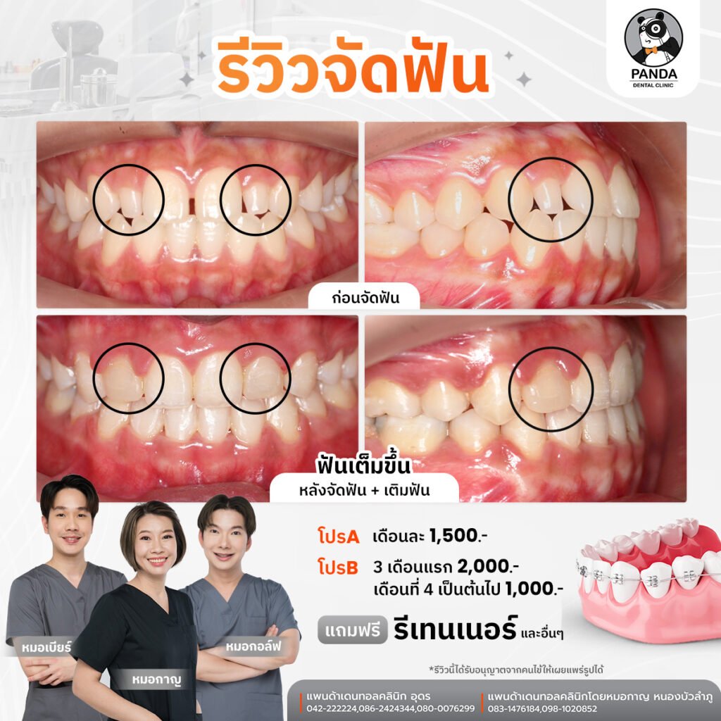 ผลลัพธ์จัดฟันแบบใส Before After Panda Dental Clinic หนองบัวลำภู