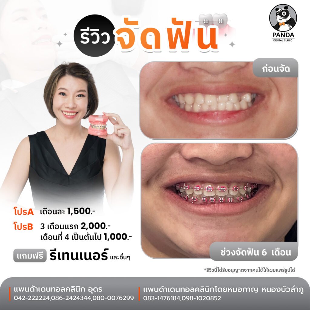 ผลลัพธ์จัดฟันแบบเหล็ก Before After Panda Dental Clinic อุดรธานี