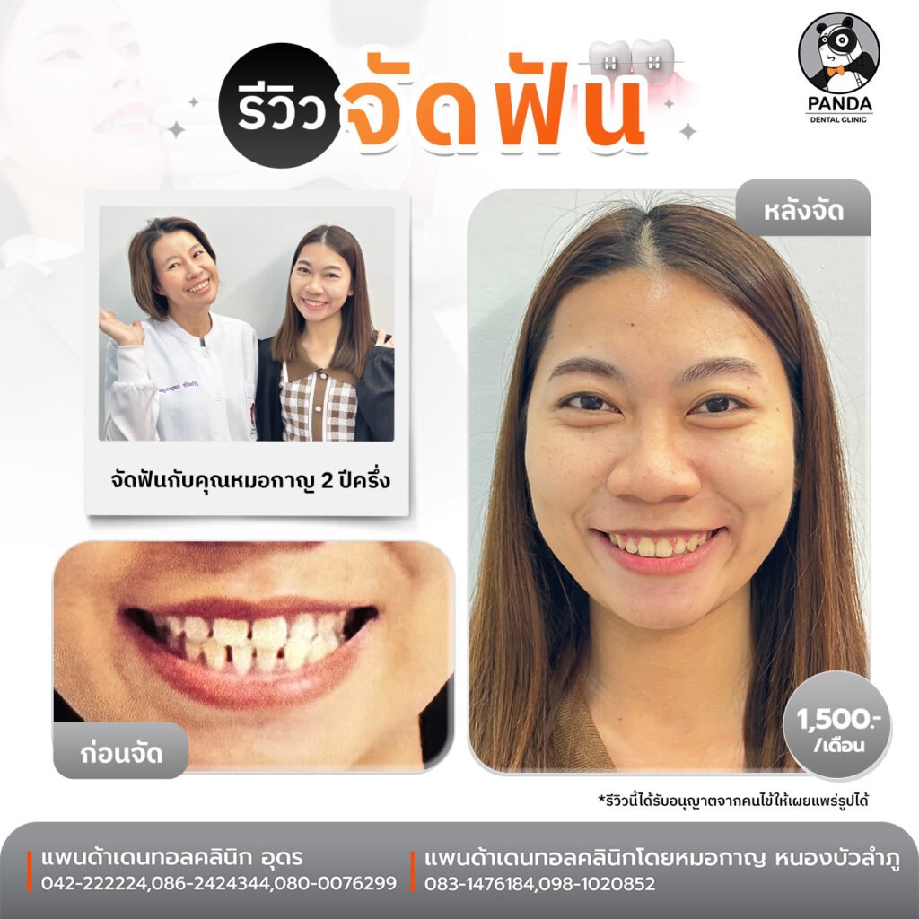 เคสจัดฟัน Before After คลินิกทันตกรรม Panda Dental